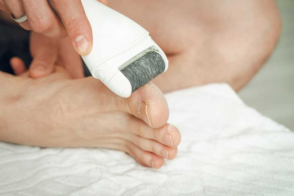 hornhautentferner-person_entfernt_hornhaut_von_zehen